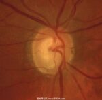 原发性开角型青光眼-眼疾-插图-1 原发性开角型青光眼-眼疾-插图-1