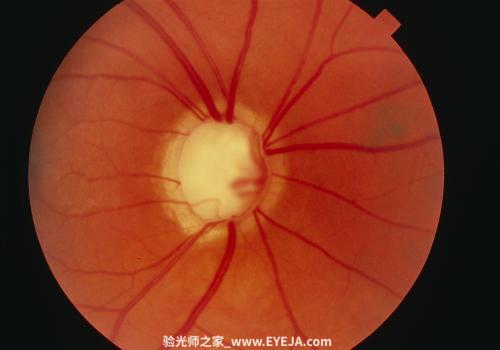 原发性开角型青光眼-眼疾-插图-2 原发性开角型青光眼-眼疾-插图-2