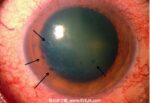大疱性角膜病变-眼疾-插图- 大疱性角膜病变-眼疾-插图-