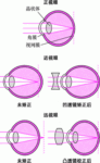 屈光不正的概述-插图-1 屈光不正的概述-插图-1