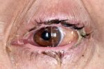 急性细菌性与感染性结膜炎-眼疾-插图-3 急性细菌性与感染性结膜炎-眼疾-插图-3