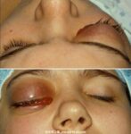 眶隔前和眼眶蜂窝织炎-眼疾-插图-2 眶隔前和眼眶蜂窝织炎-眼疾-插图-2