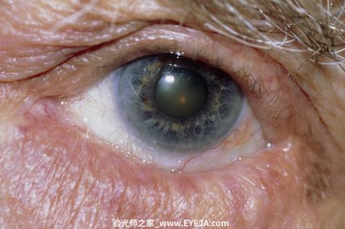 睑内翻和睑外翻-眼疾-插图- 睑内翻和睑外翻-眼疾-插图-
