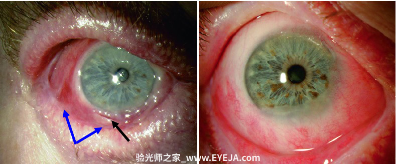 眼粘膜类天疱疮-眼疾