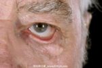 睑内翻和睑外翻-眼疾-插图-1 睑内翻和睑外翻-眼疾-插图-1