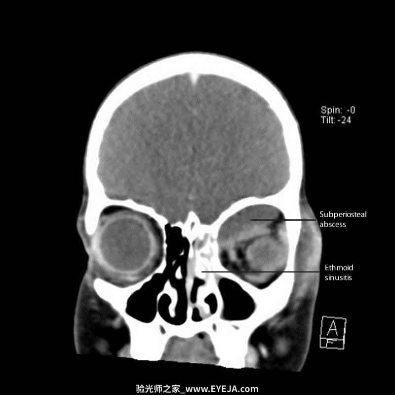 眶隔前和眼眶蜂窝织炎-眼疾-插图-3 眶隔前和眼眶蜂窝织炎-眼疾-插图-3
