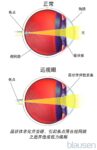屈光不正的概述-插图-2 屈光不正的概述-插图-2