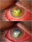 角膜溃疡-眼疾-插图-1 角膜溃疡-眼疾-插图-1