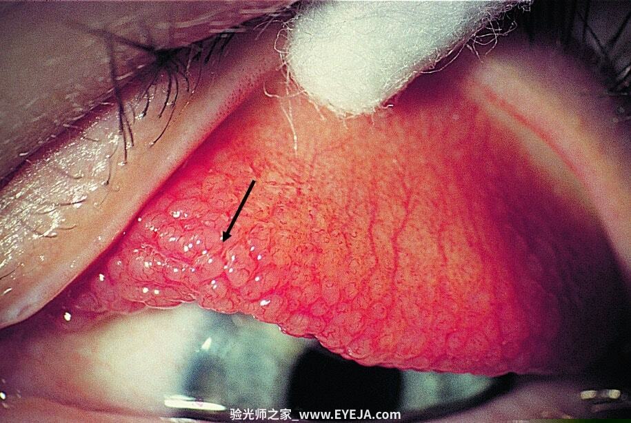 过敏性结膜炎-眼疾-插图-1 过敏性结膜炎-眼疾-插图-1