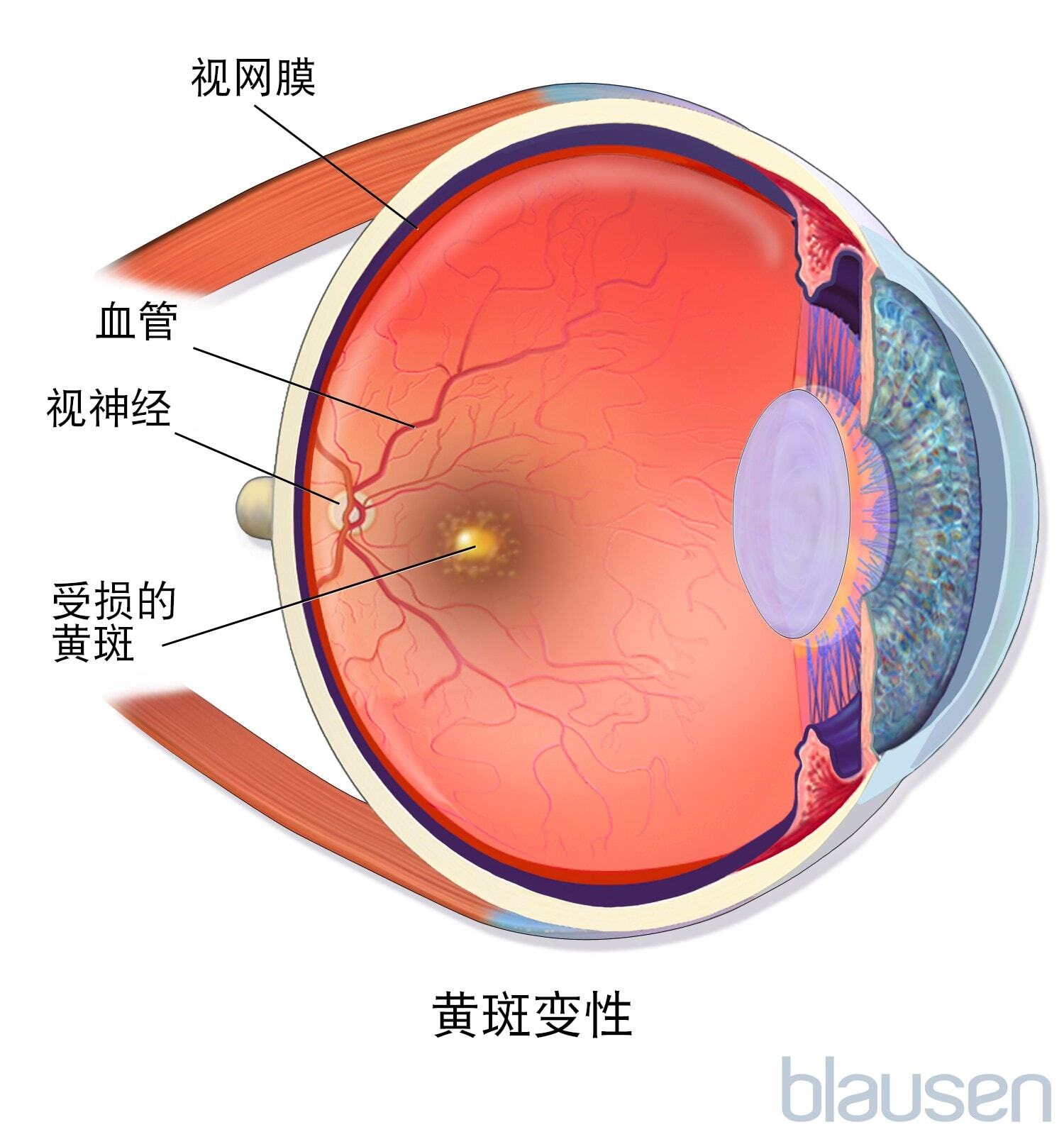 年龄相关性黄斑变性(AMD或ARMD)-眼疾