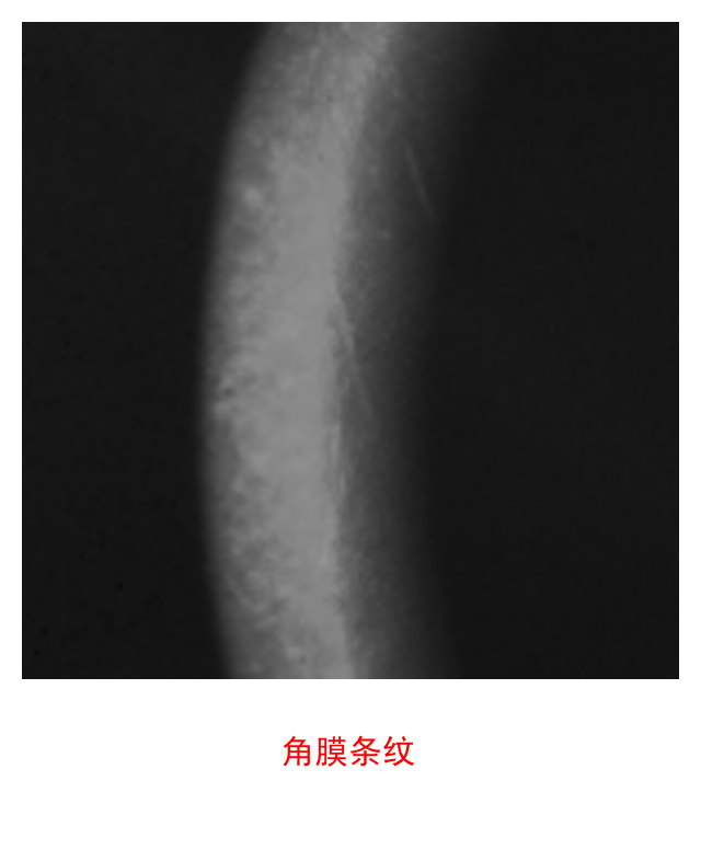 图集-缺氧和角膜水肿(软镜)-插图-5 图集-缺氧和角膜水肿(软镜)-插图-5