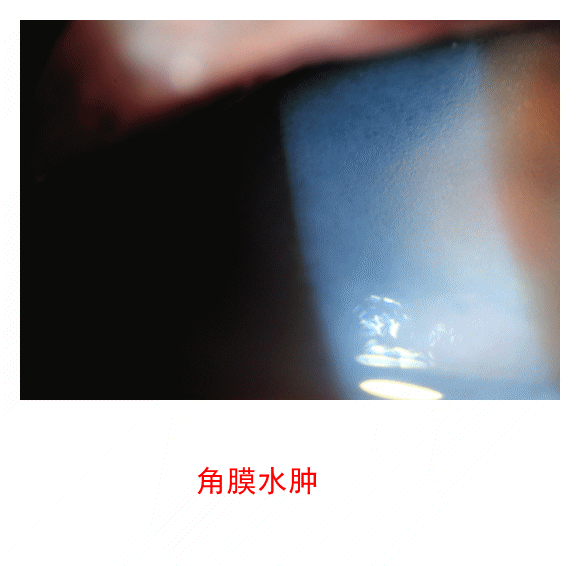 图集-缺氧和角膜水肿(软镜)-插图-7 图集-缺氧和角膜水肿(软镜)-插图-7