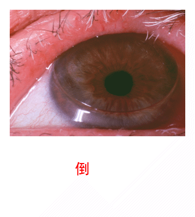 3.2.5 眼睑病、角膜病诊断检查案例-1 眼睑病、角膜病诊断检查案例-图片集