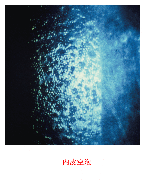 图集-缺氧和角膜水肿(软镜)-插图- 图集-缺氧和角膜水肿(软镜)-插图-