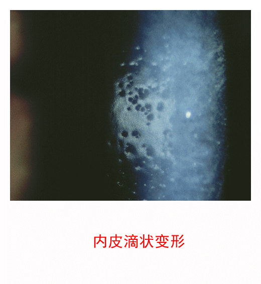 图集-缺氧和角膜水肿(软镜)-插图-1 图集-缺氧和角膜水肿(软镜)-插图-1