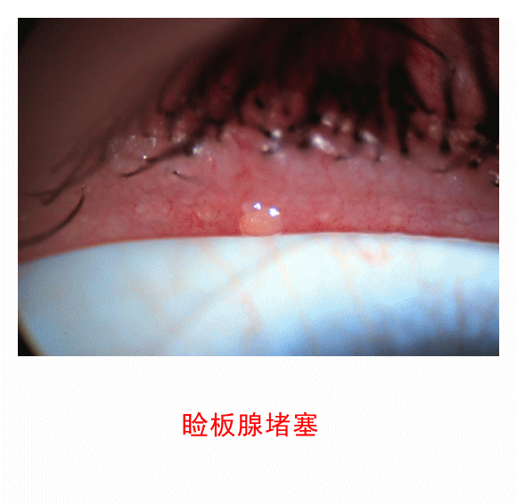 3.2.5 眼睑病、角膜病诊断检查案例-7 眼睑病、角膜病诊断检查案例-图片集