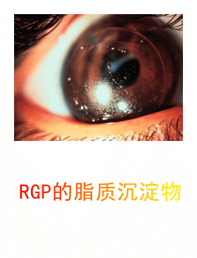 3.2.6 角膜接触镜沉淀物鉴别-1 角膜接触镜沉淀物鉴别-图集