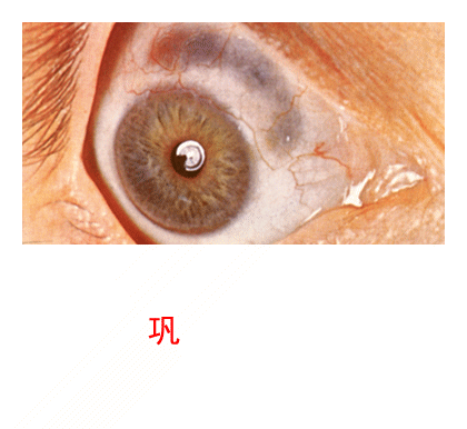 3.2.5 眼睑病、角膜病诊断检查案例-3 眼睑病、角膜病诊断检查案例-图片集
