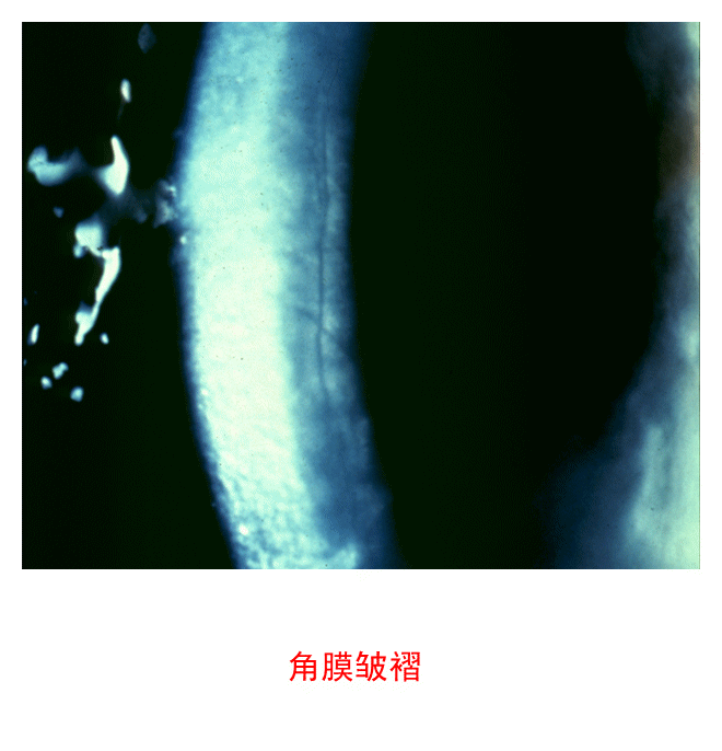 图集-缺氧和角膜水肿(软镜)-插图-3 图集-缺氧和角膜水肿(软镜)-插图-3