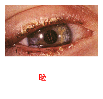 3.2.5 眼睑病、角膜病诊断检查案例-8 眼睑病、角膜病诊断检查案例-图片集
