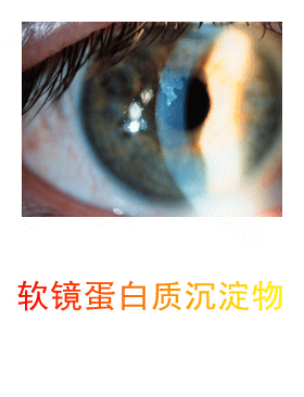 3.2.6 角膜接触镜沉淀物鉴别-1 角膜接触镜沉淀物鉴别-图集