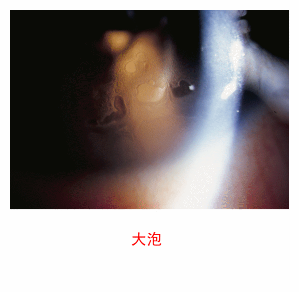 图集-缺氧和角膜水肿(软镜)