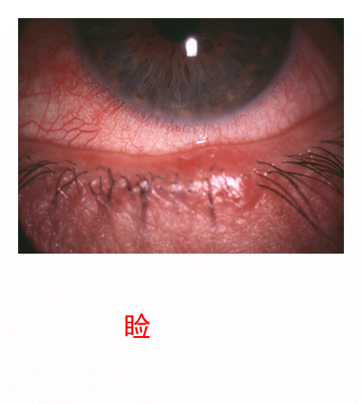 3.2.5 眼睑病、角膜病诊断检查案例-6 眼睑病、角膜病诊断检查案例-图片集
