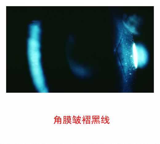 图集-缺氧和角膜水肿(软镜)-插图-4 图集-缺氧和角膜水肿(软镜)-插图-4