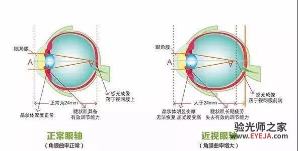 花20万治孩子近视,没想到度数断崖式增加,近视能治愈?这绝对是个骗局! 花20万治孩子近视,没想到度数断崖式增加,近视能治愈?这绝对是个骗局!