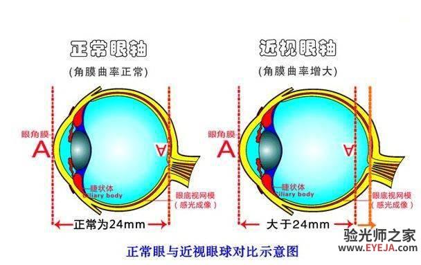 如何正确理解“裸眼视力”和“屈光度”的关系? 如何正确理解“裸眼视力”和“屈光度”的关系?
