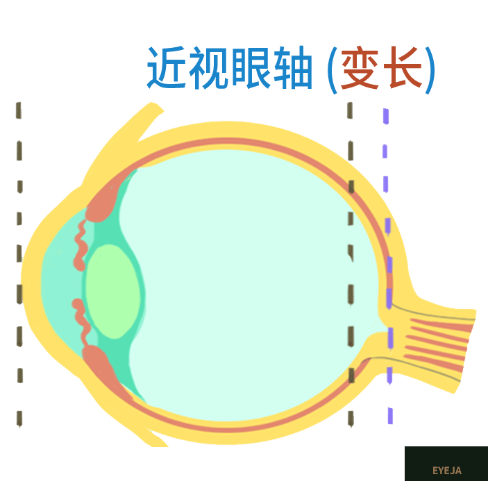 一文读懂|为啥要给孩子测眼轴? 一文读懂|为啥要给孩子测眼轴?