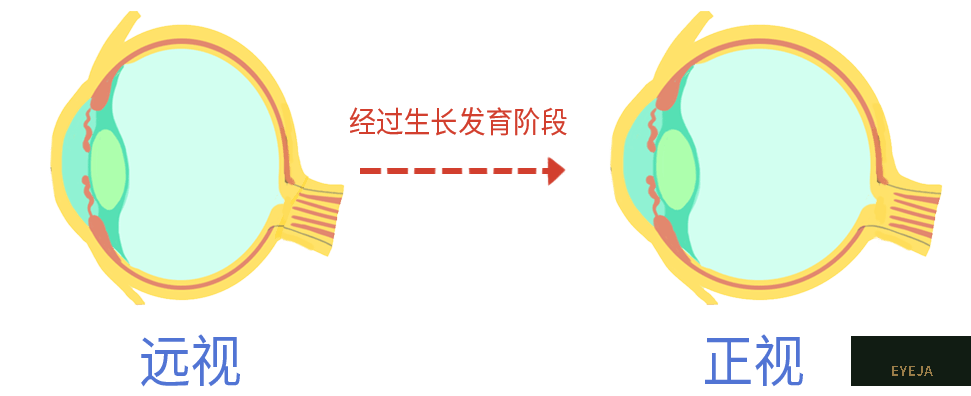一文读懂|为啥要给孩子测眼轴? 一文读懂|为啥要给孩子测眼轴?
