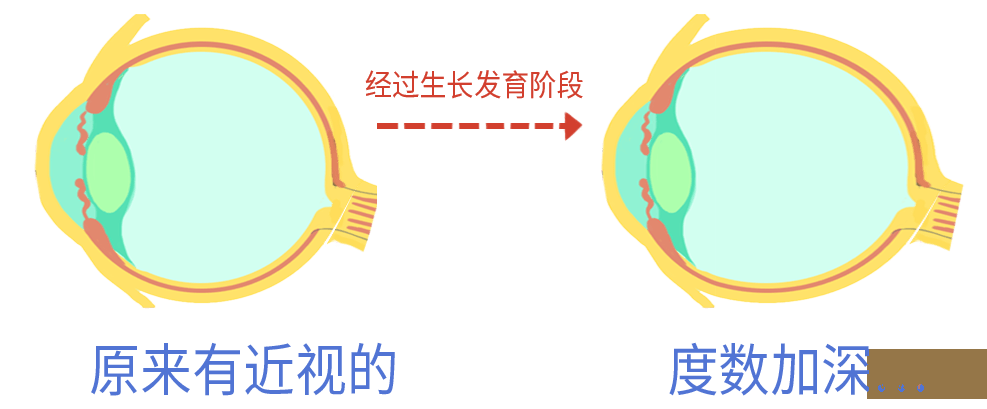 一文读懂|为啥要给孩子测眼轴? 一文读懂|为啥要给孩子测眼轴?