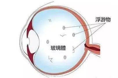 飞蚊症不管行不行?