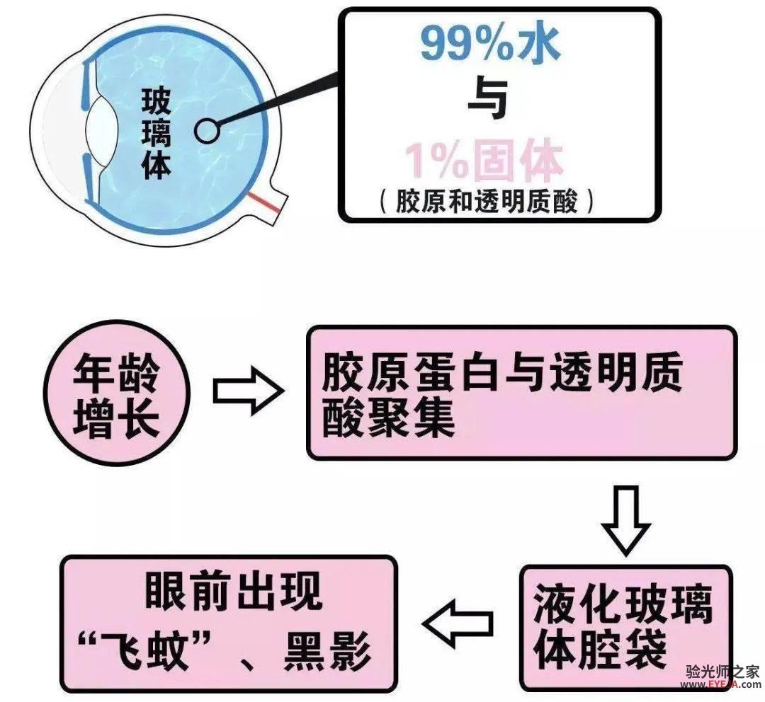 飞蚊症不管行不行? 飞蚊症不管行不行?
