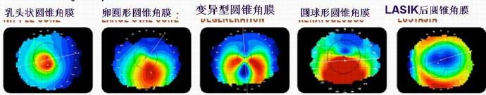 圆锥角膜的地形图的应用和分析 圆锥角膜的地形图的应用和分析