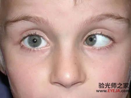孩子弱视不能拖,千万别错过治疗黄金期! 孩子弱视不能拖,千万别错过治疗黄金期!