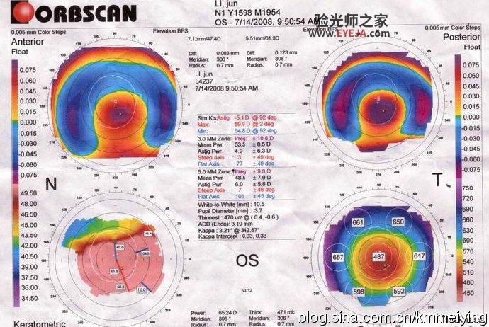 RGP对圆锥角膜塑形作用案例 RGP对圆锥角膜塑形作用案例
