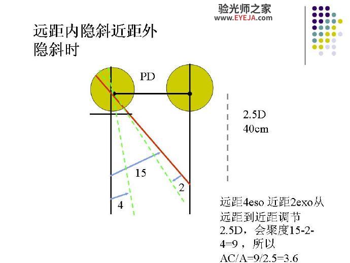 AC/A——调节性集合与调节的比率 AC/A——调节性集合与调节的比率
