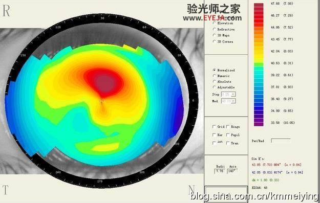 几个与单纯散光类似的圆锥角膜案例 几个与单纯散光类似的圆锥角膜案例