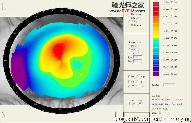 几个与单纯散光类似的圆锥角膜案例 几个与单纯散光类似的圆锥角膜案例