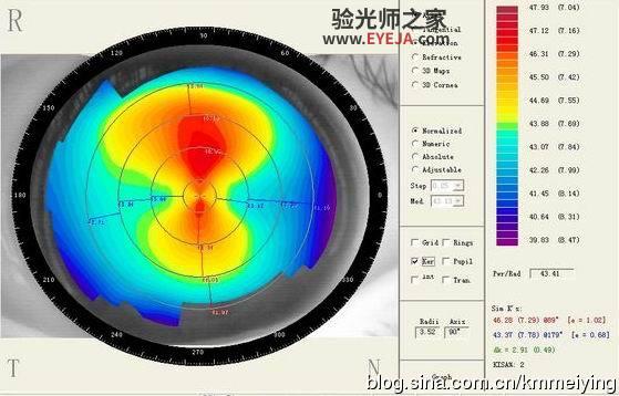 几个与单纯散光类似的圆锥角膜案例 几个与单纯散光类似的圆锥角膜案例