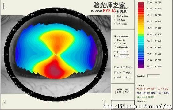 几个与单纯散光类似的圆锥角膜案例 几个与单纯散光类似的圆锥角膜案例