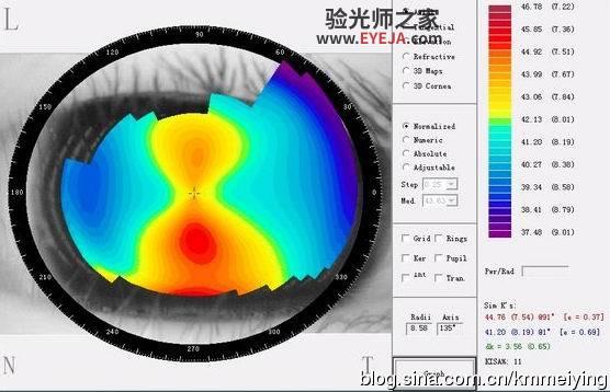 几个与单纯散光类似的圆锥角膜案例 几个与单纯散光类似的圆锥角膜案例