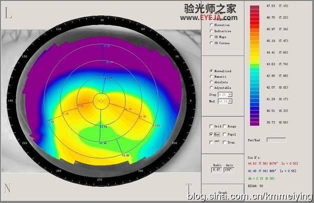 几个与单纯散光类似的圆锥角膜案例 几个与单纯散光类似的圆锥角膜案例
