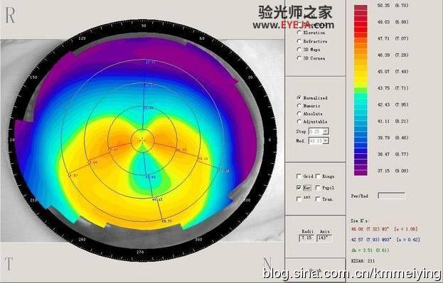 几个与单纯散光类似的圆锥角膜案例 几个与单纯散光类似的圆锥角膜案例