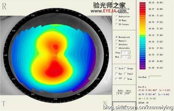 几个与单纯散光类似的圆锥角膜案例 几个与单纯散光类似的圆锥角膜案例
