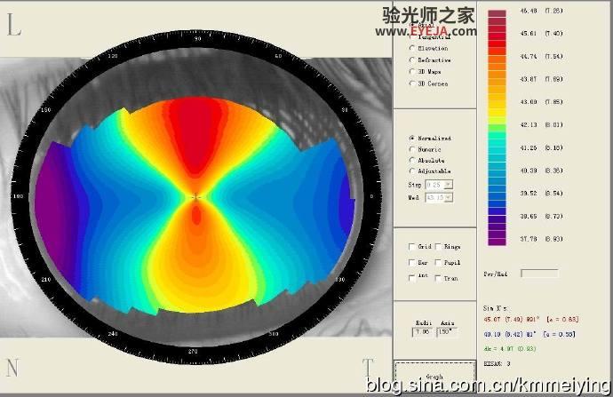 被误诊为圆锥角膜一例 被误诊为圆锥角膜一例