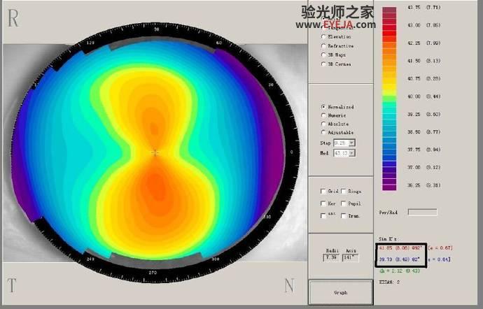角膜塑形中的角膜地形图初步阅读