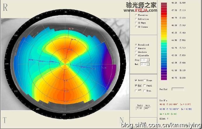 RGP塑形作用导致误认圆锥角膜一例 RGP塑形作用导致误认圆锥角膜一例